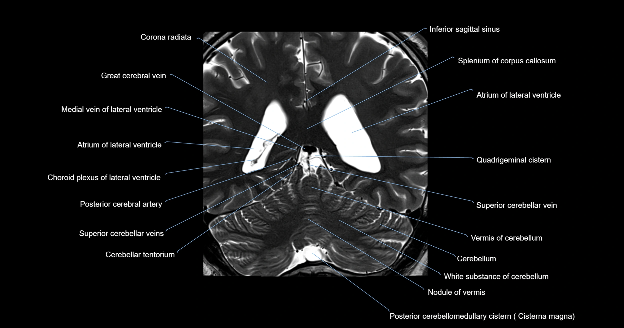 MRI brainstem & basal ganglia anatomy labelled 3T MRI images -img-00001-00035.webp